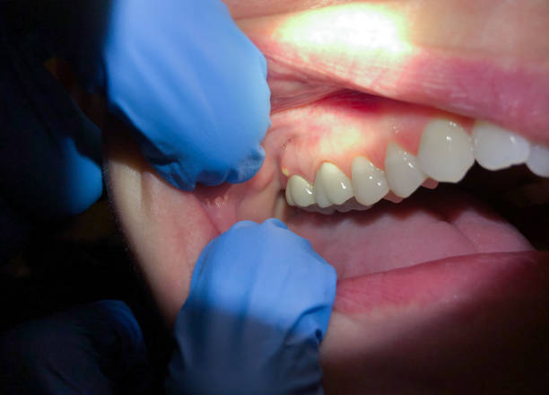 Best Emergency Treatment for Toothache in Renville, MN